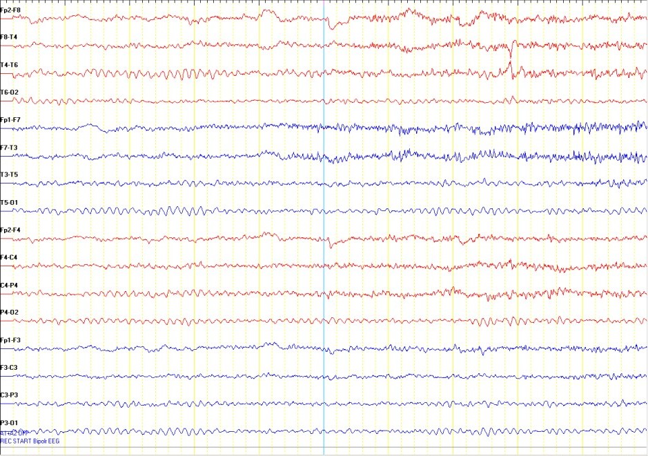 what does a seizure look like standard eeg entabeni epilepsy laboratory what does a seizure look like standard eeg entabeni epilepsy laboratory