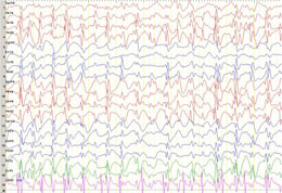 Abnormal EEG